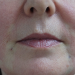 Patient 1 Hour After Thread Lift