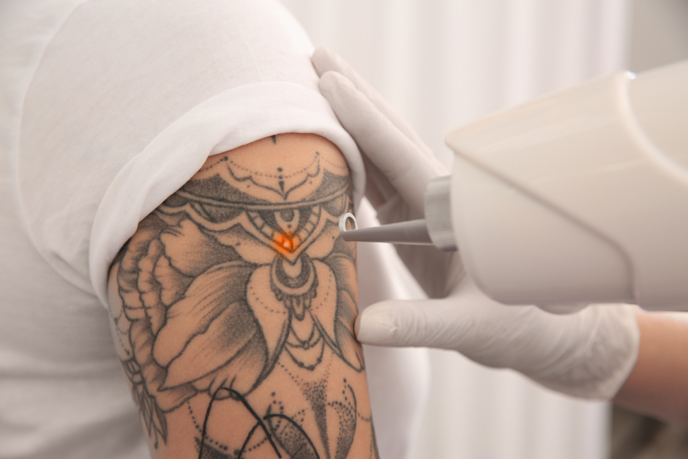 Laser Tattoo Removal