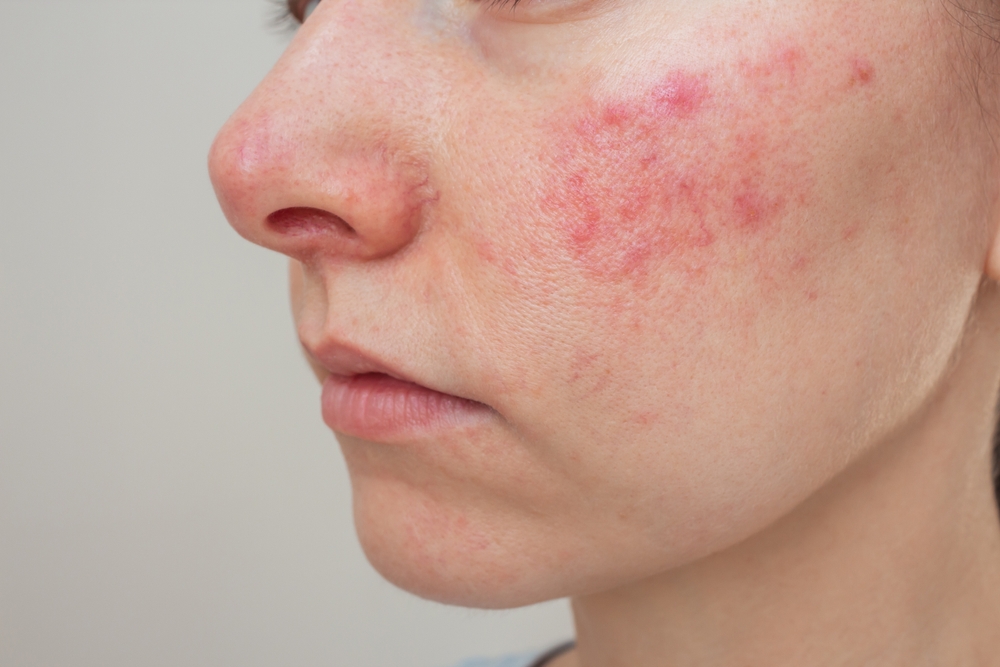 Close-up,Profile,Of,A,Young,Caucasian,Woman,Suffering,From,The