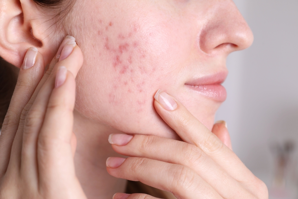 Woman,With,Acne,Problem,At,Home,,Closeup