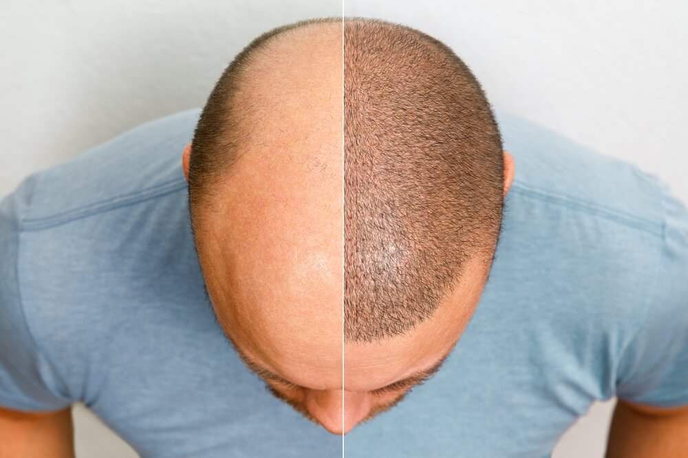 Hair Transplants - What Results To Expect After 6-12 Months