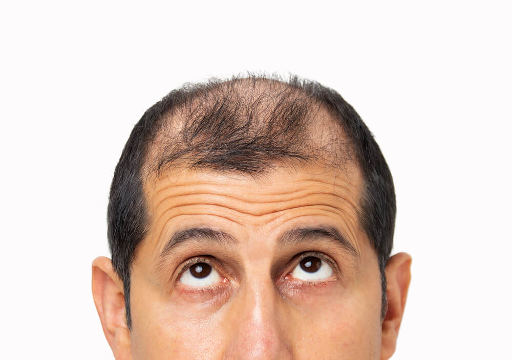 Do Hair Transplants Actually Work